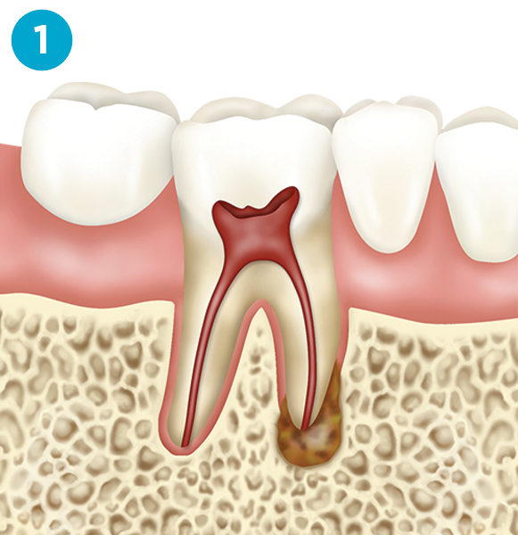 implant step one