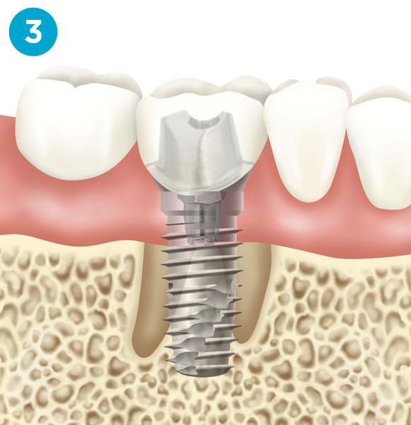 implant step one